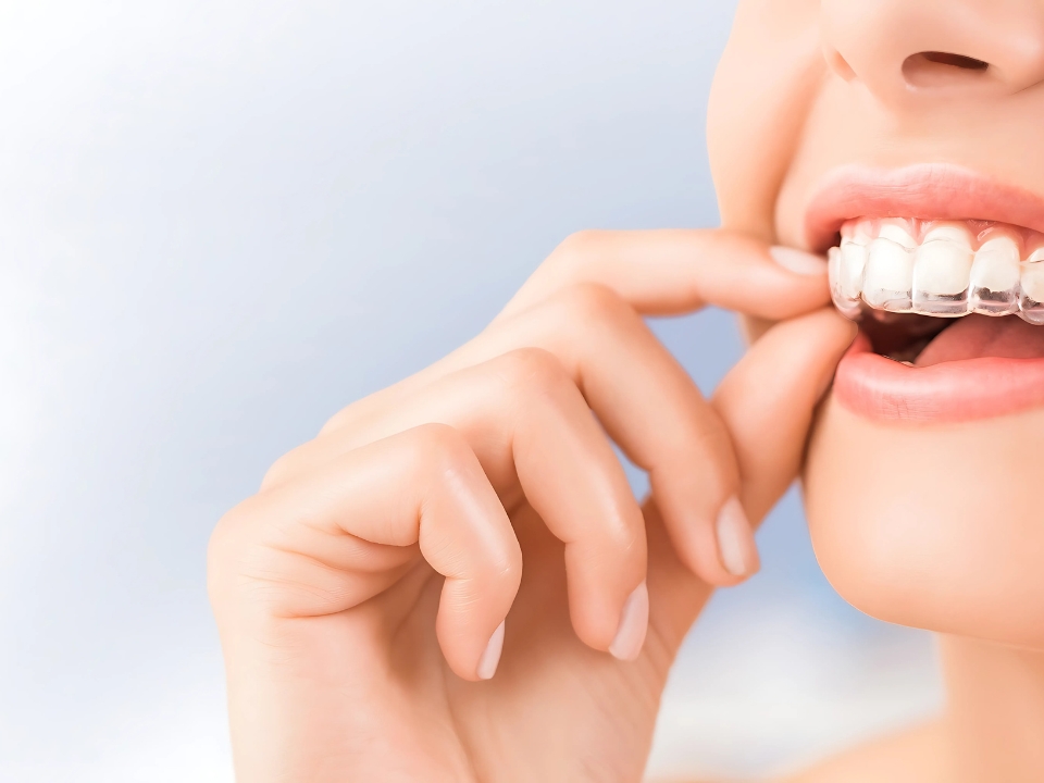 braces treatment in Baner