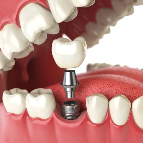 dental implant in Baner